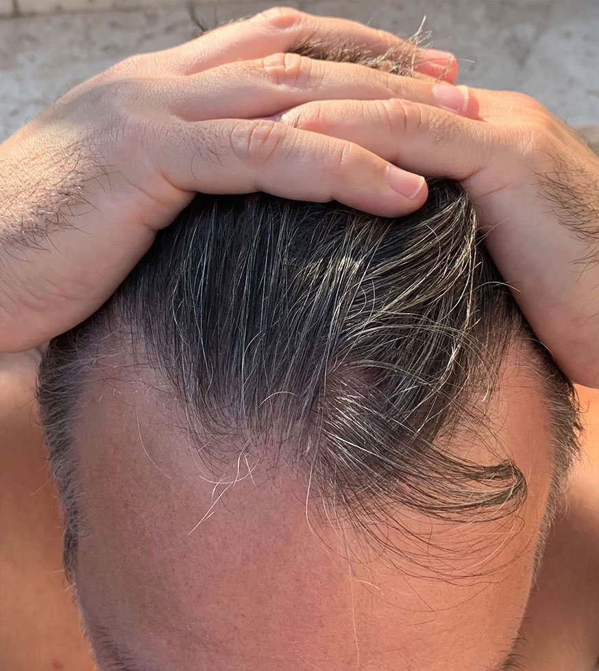 Vorher Nachher Bilder Haartransplantation. Haartransplantation Linz Vorher Nachher Fotos. Haartransplantation Österreich Ergebnisse, Erfahrungen Haarverpflanzung Vorher-Nachher Bilder