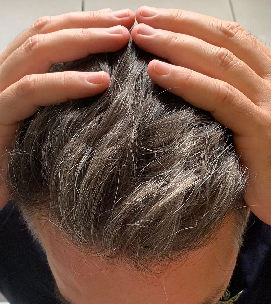 Vorher Nachher Bilder Haartransplantation. Haartransplantation Linz Vorher Nachher Fotos. Haartransplantation Österreich Ergebnisse, Erfahrungen Haarverpflanzung Vorher-Nachher Bilder