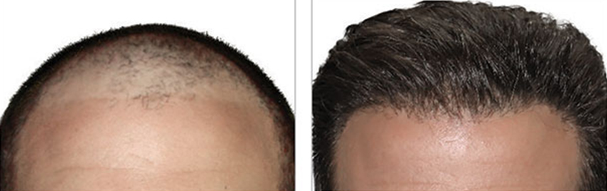Vorher Nachher Bilder Haartransplantation. Haartransplantation Linz Vorher Nachher Fotos. Haartransplantation Österreich Ergebnisse, Erfahrungen Haarverpflanzung Vorher-Nachher Bilder